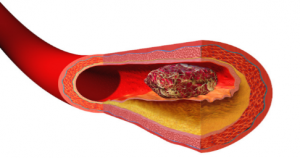 A blood clot blocking a blood vessel. Source Wikipedia